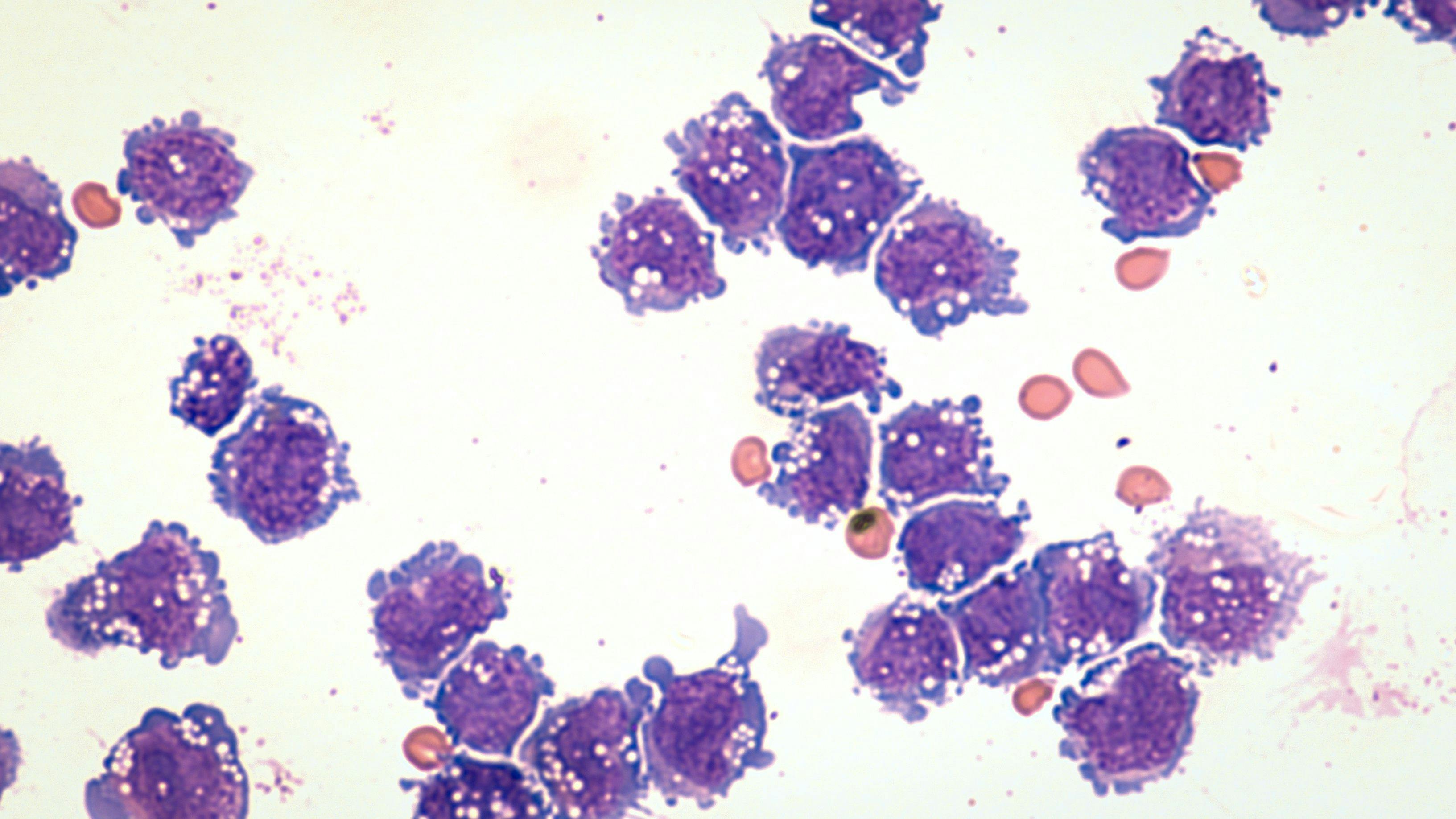 Malignant effusion cytology microscopic image of diffuse large B-cell lymphoma a type of non Hodgkin lymphoma | Image credit: David A Litman - stock.adobe.com