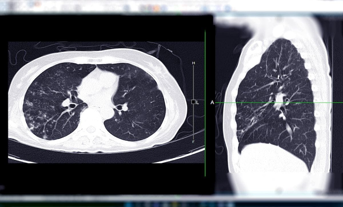 CT Chest or CT Scan of Lung Axial and Coronal View | Image Credit: samunella - stock.adobe.com
