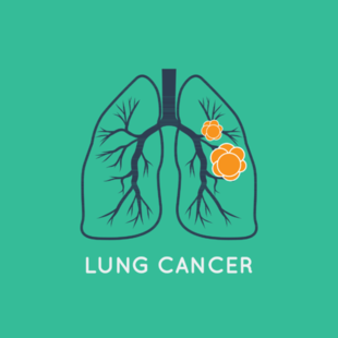 Underlying Pathway in Lung Cancer Could Identify Appropriate Targeted Treatments