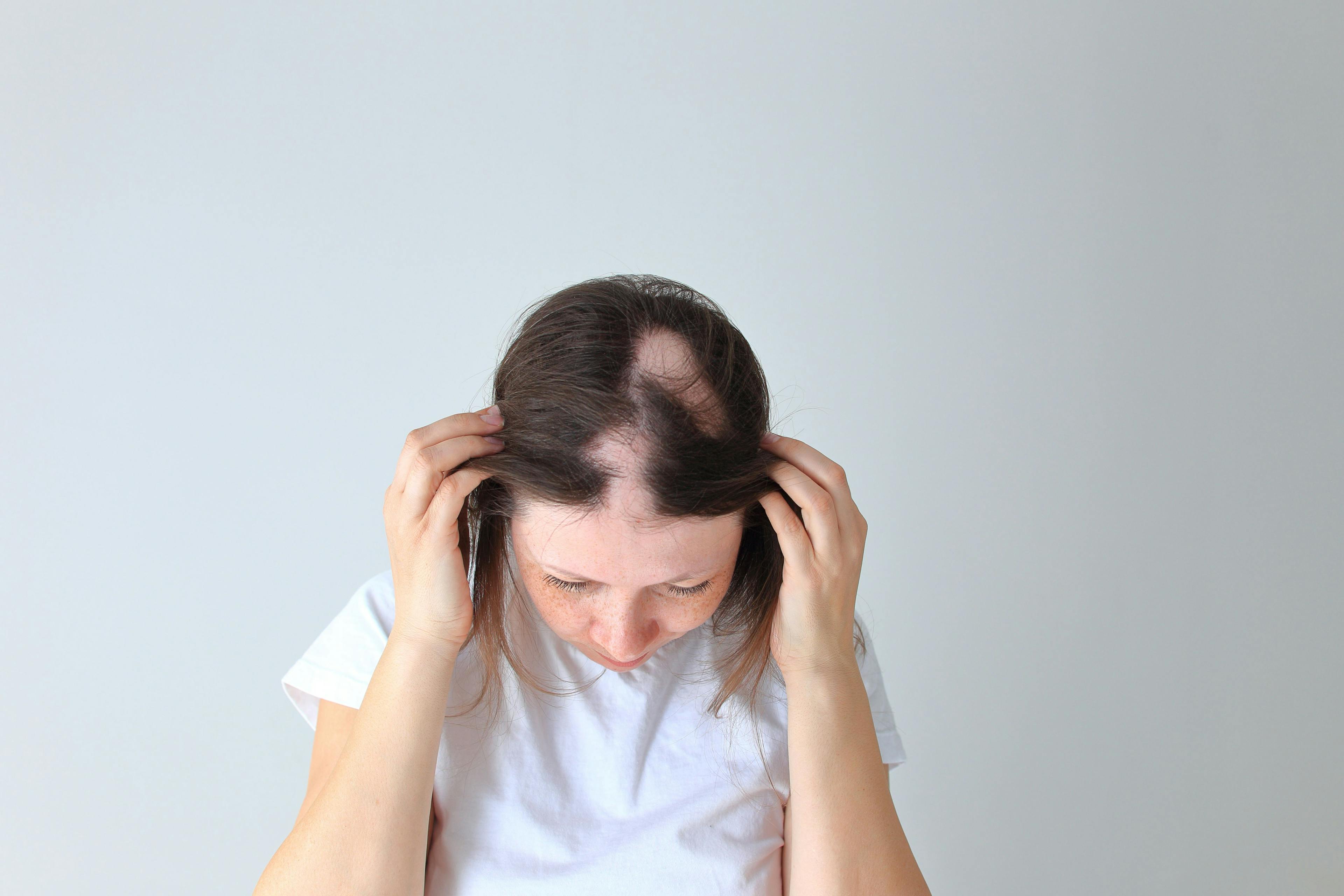 Real alopecia areata in a young girl | Image credit: Nadya Kolobova - stock.adobe.com
