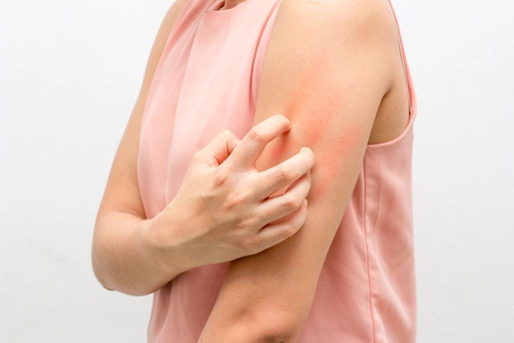 woman scratching arm with atopic dermatitis irritation