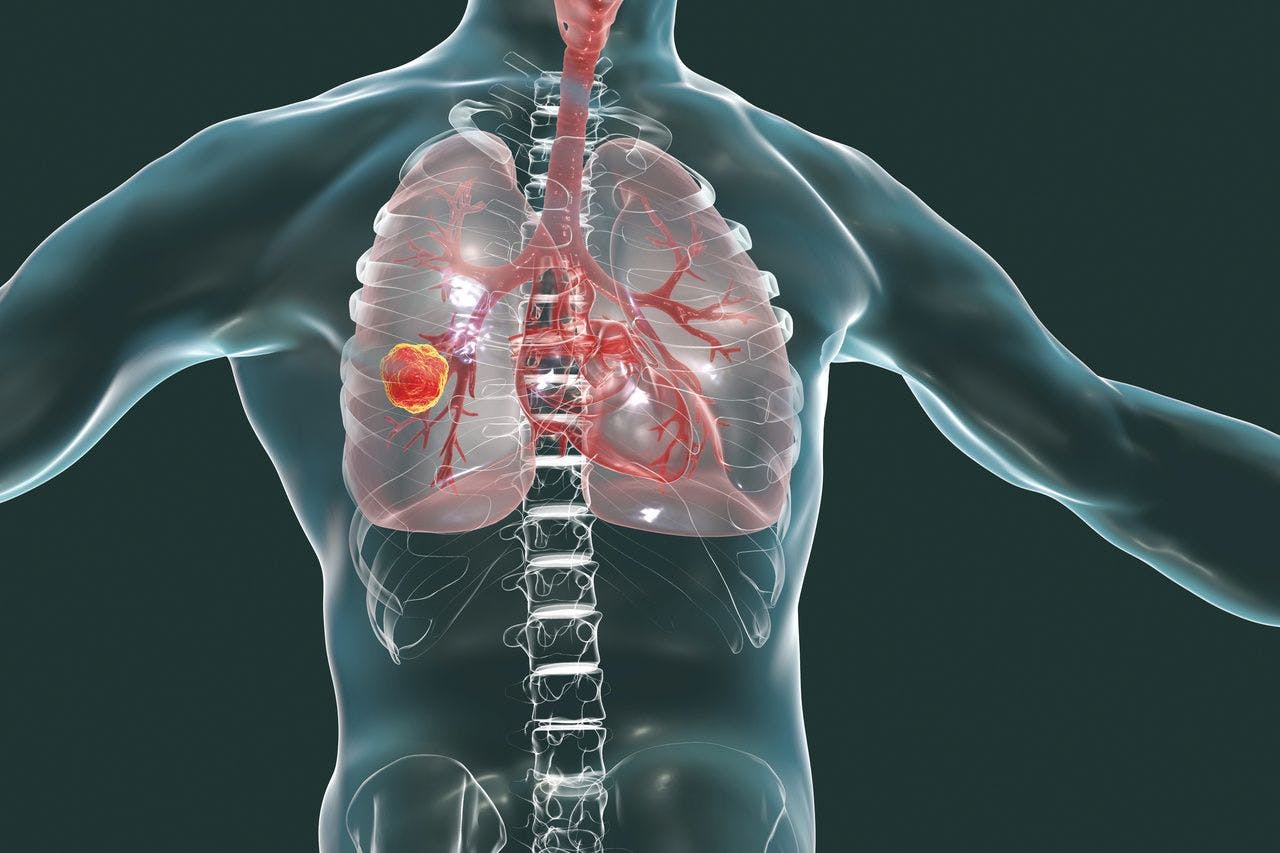 Early Detection, Resection Key to Lung Cancer Survival in Patients With Lymphoma History 