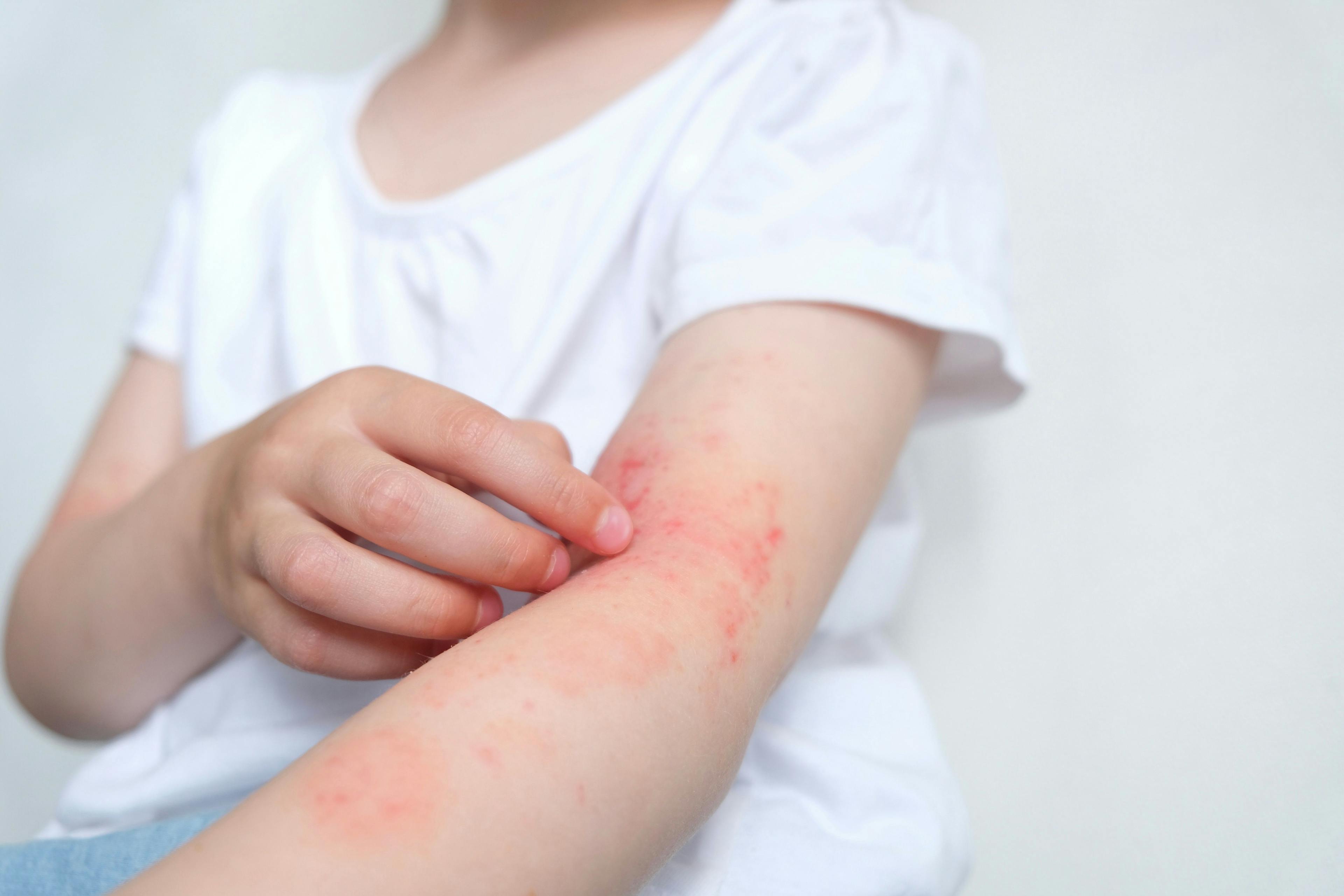 Child with atopic dermatitis | Image credit: Марина Терехова - stock.adobe.com