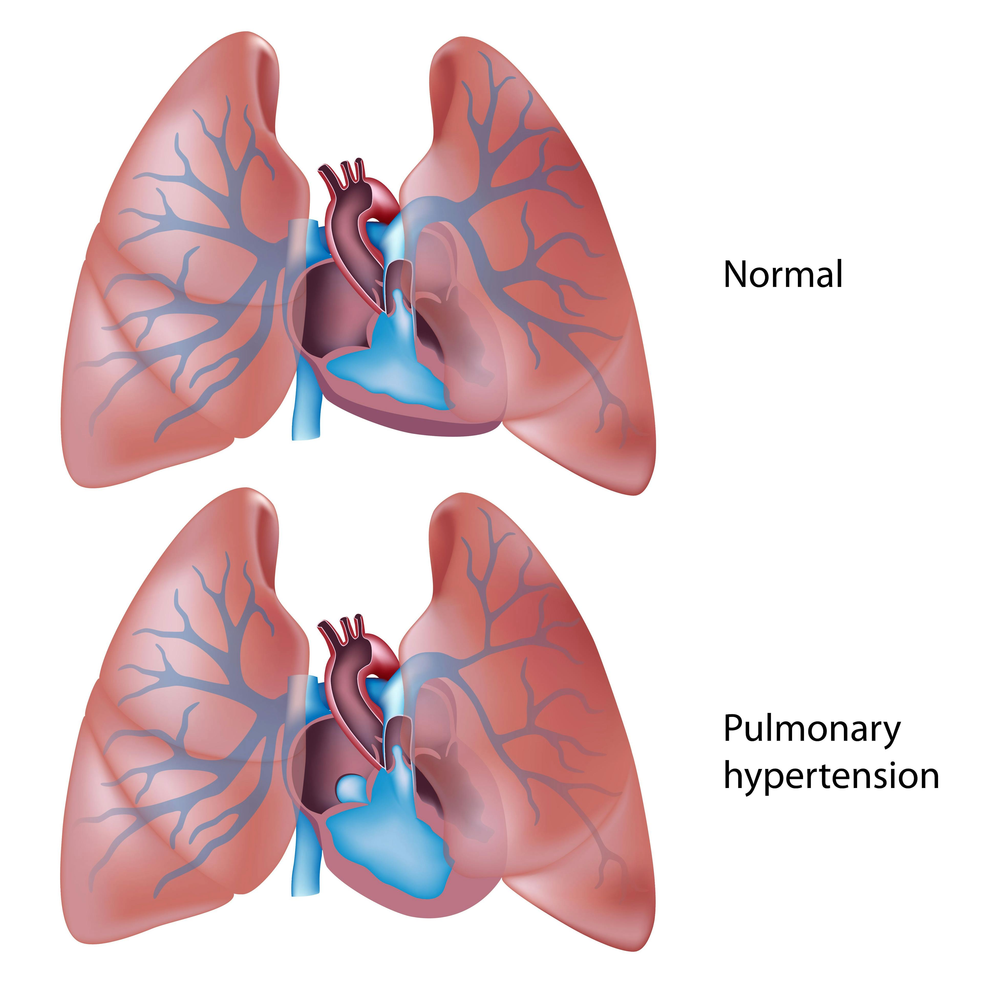 Pulmonary arterial hypertension | Image credit: Alila Medical Media - stock.adobe.com