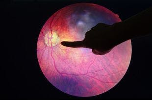 Study Finds Imaging Technique Could Replace Riskier Diagnostic Method for Diabetic Retinopathy
