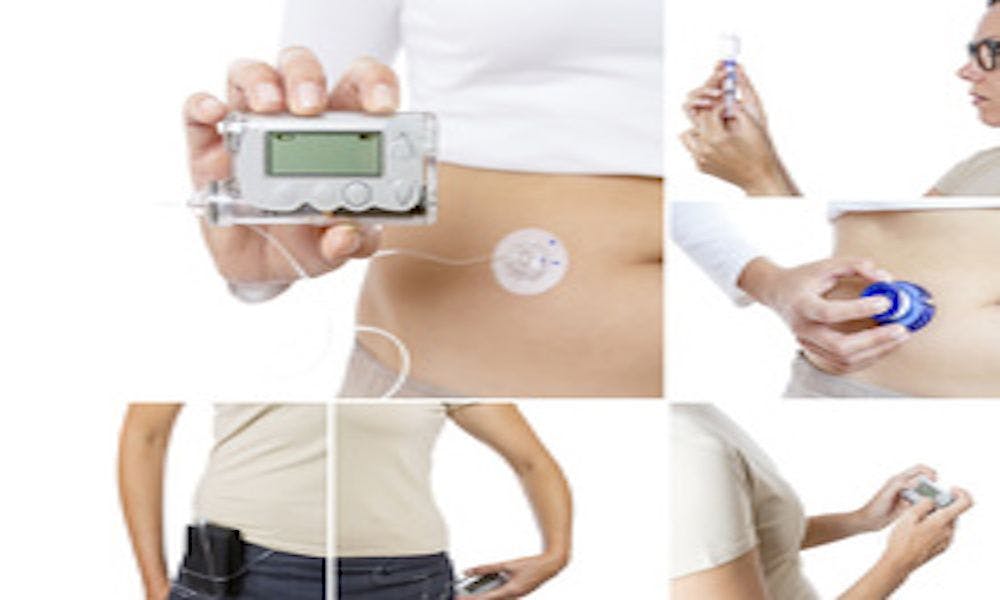 Image of automated insulin delivery