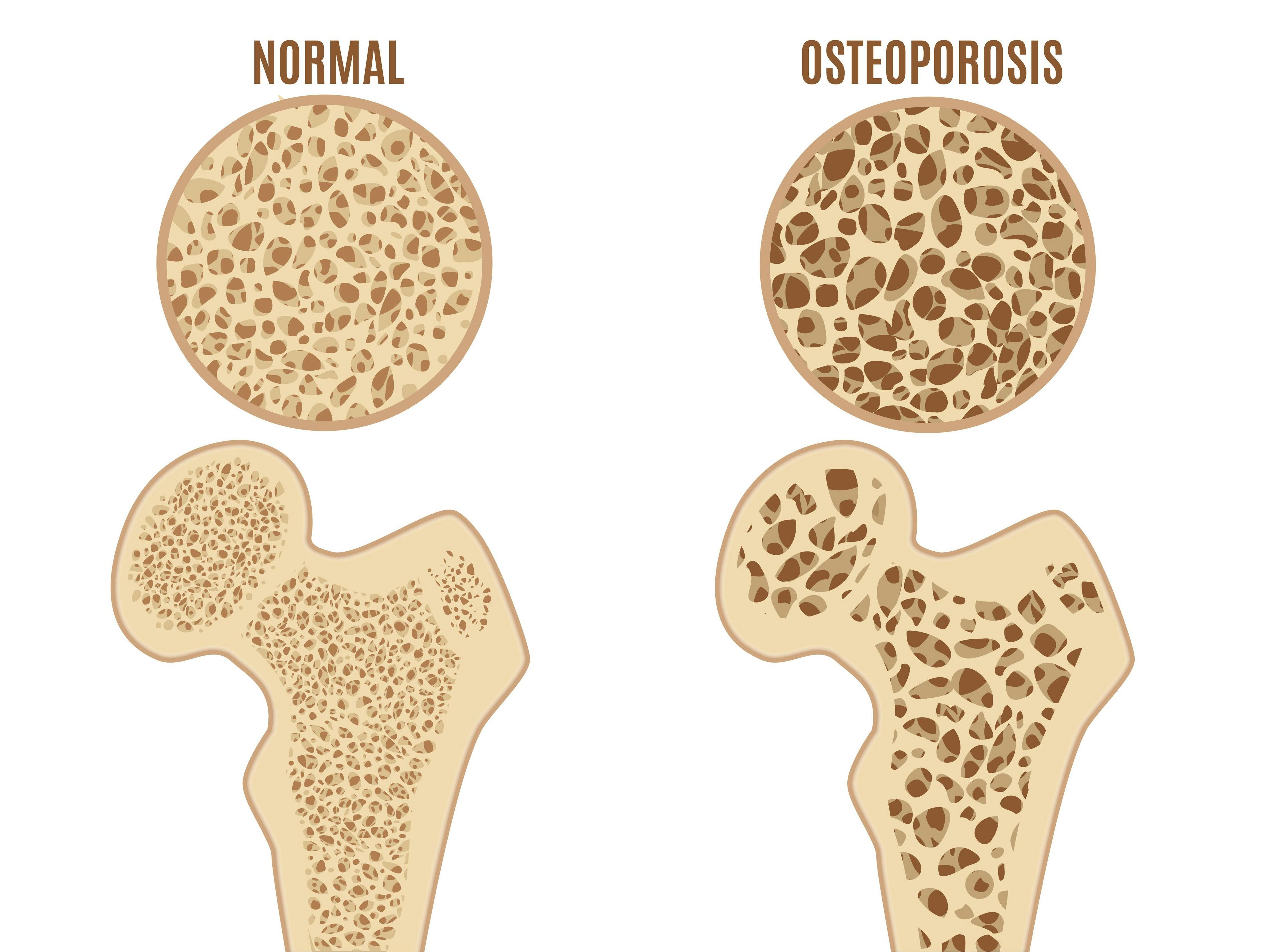 Graphic of normal bone and bone with osteoporosis | Image credit: bigmouse108 - stock.adobe.com