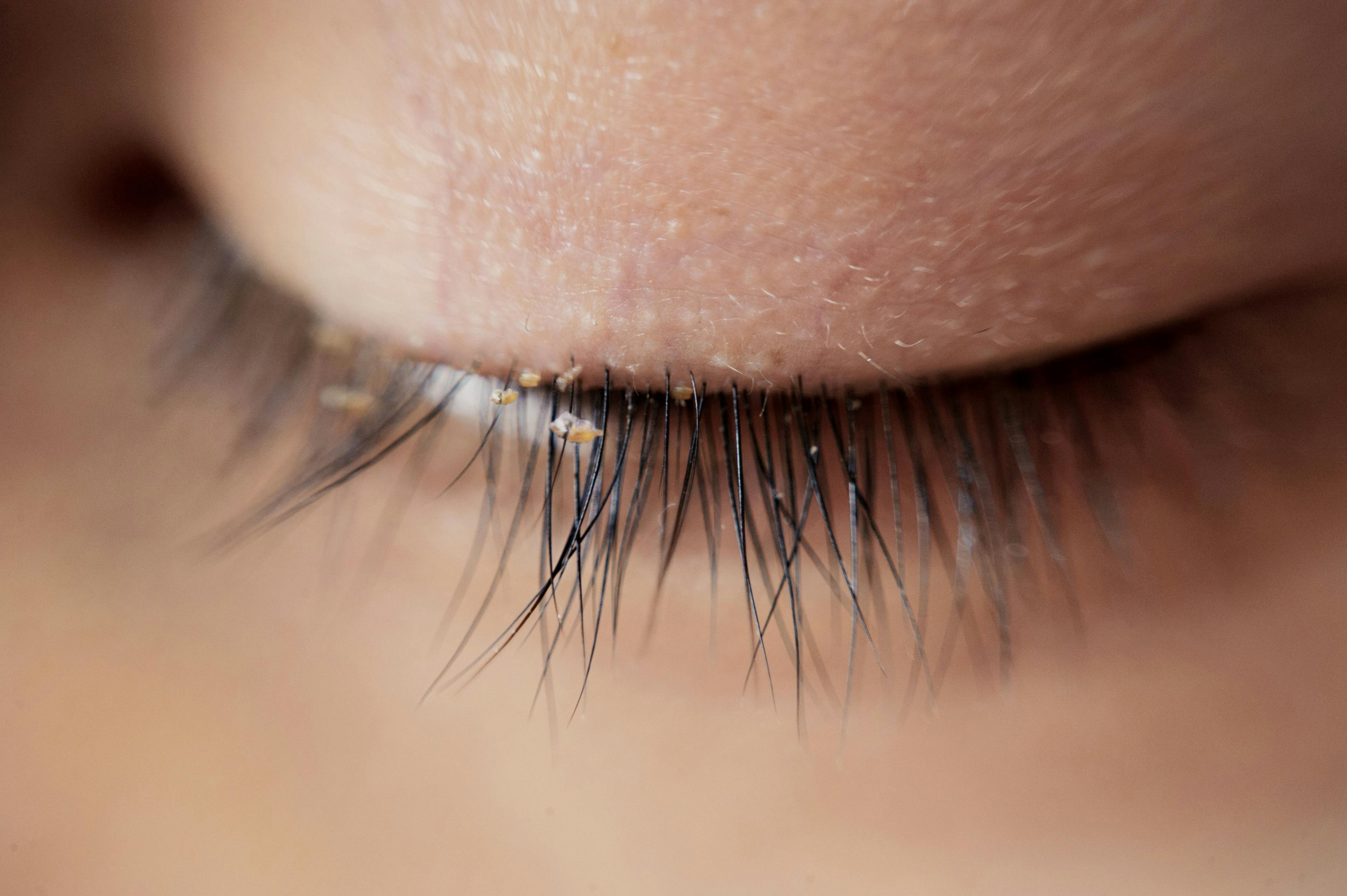 Close up severe conjunctivitis from eyelash mites | Image credit: ohishiftl - stock.adobe.com
