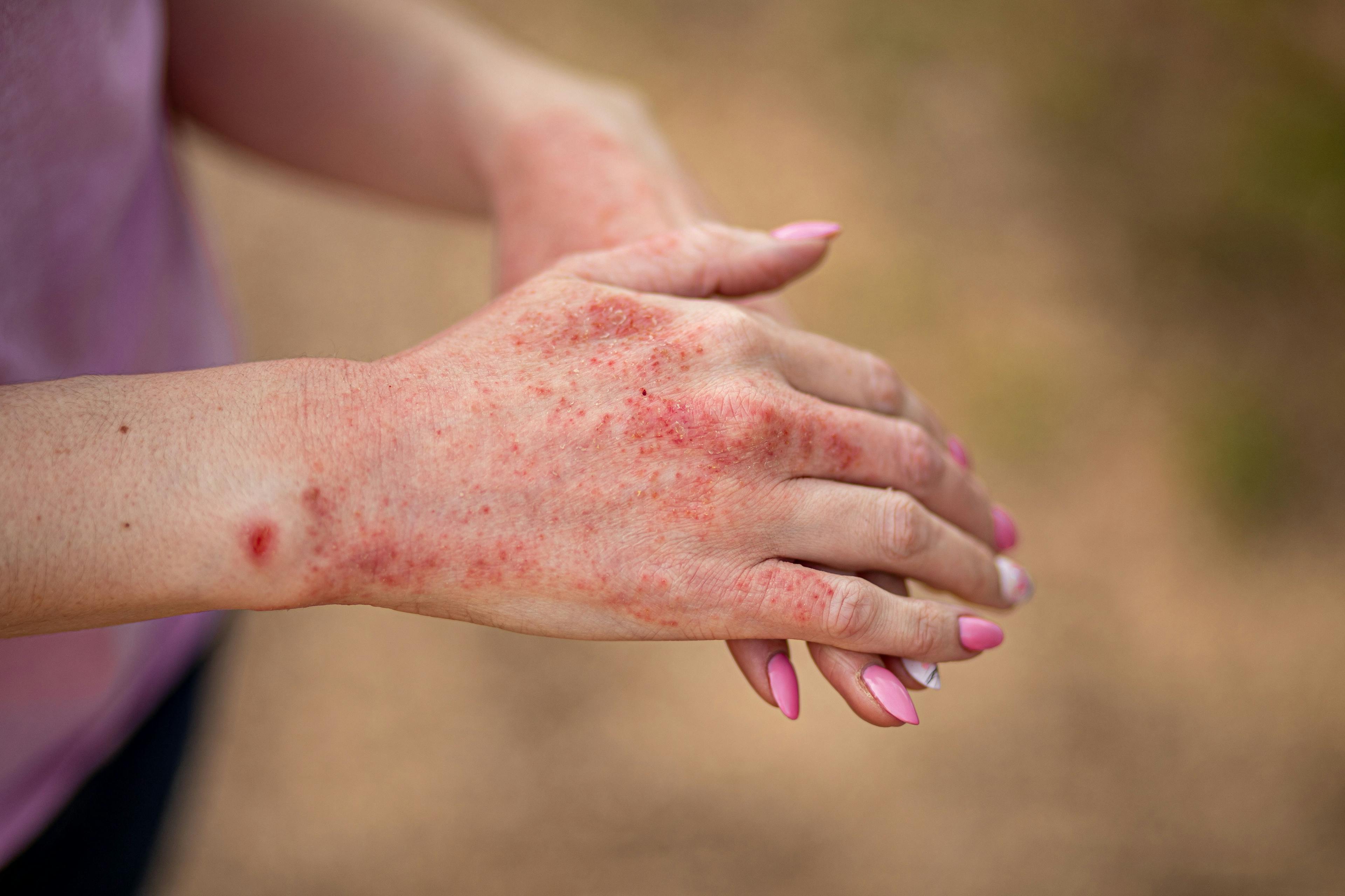 Close up dermatitis on skin, ill allergic rash eczema skin of patient, atopic dermatitis symptom skin detail texture, Fungus of skin, The concept dermatology, treatment fungal | Image credit: Irina - stock.adobe.com