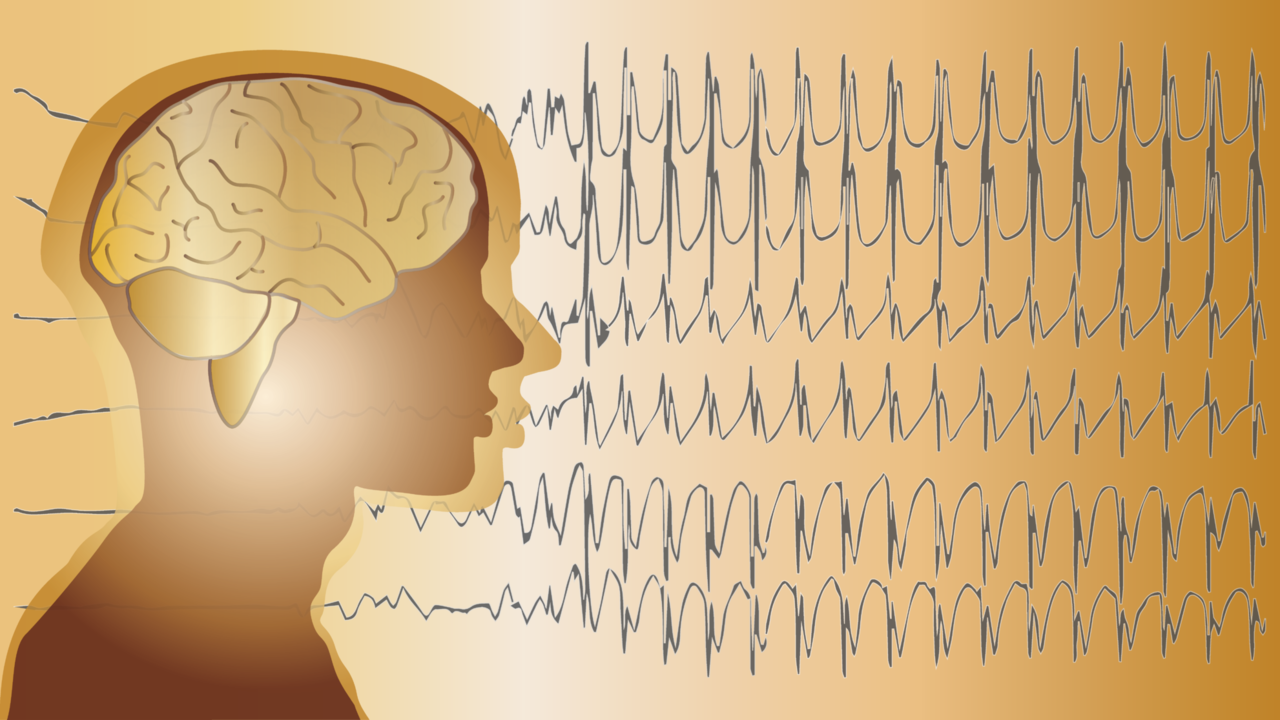 Graphic of brain waves in seizure