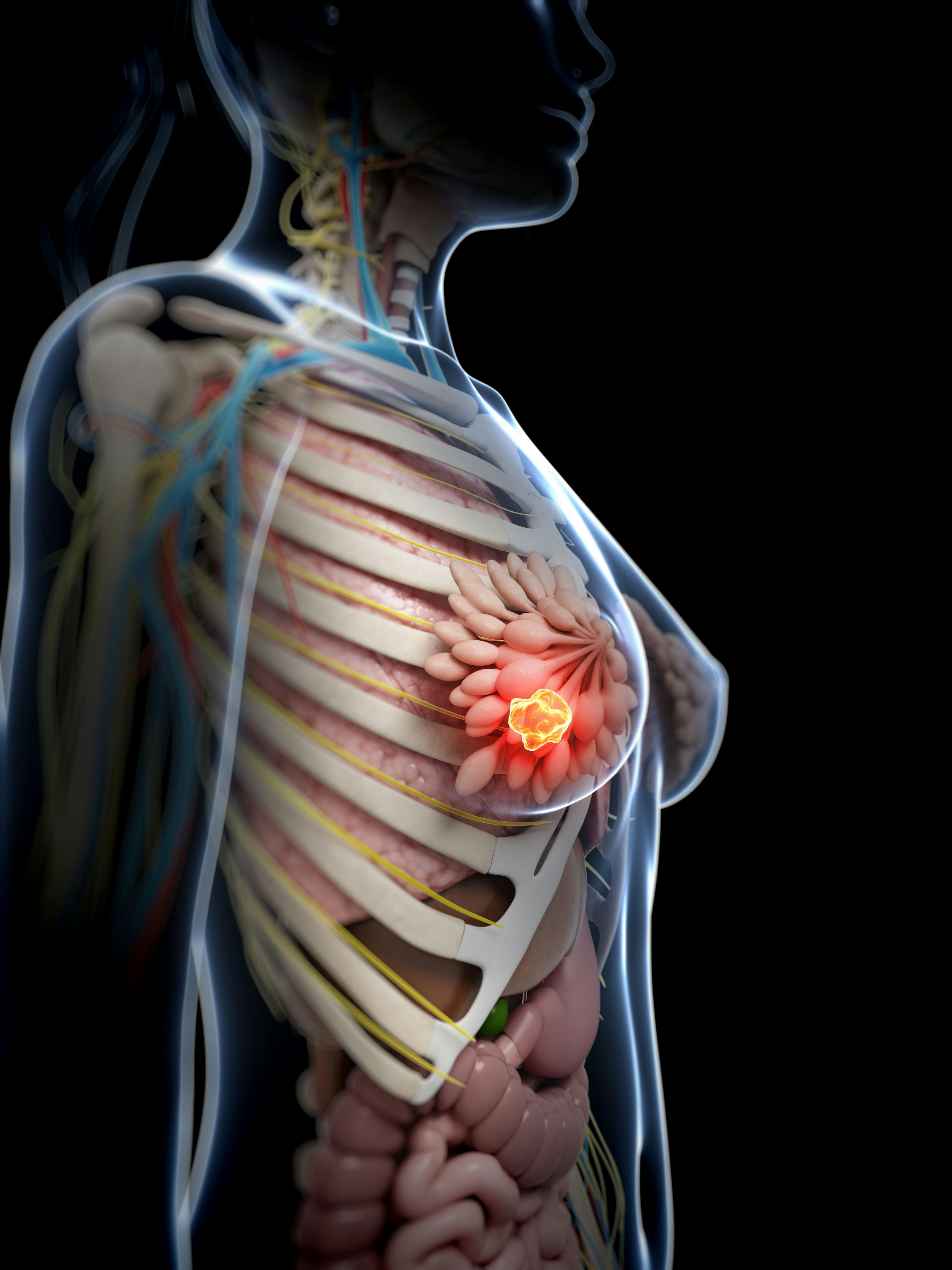 3D rendered graphic of breast cancer | Image Credit: Sebastian Kaulitzki - stock.adobe.com