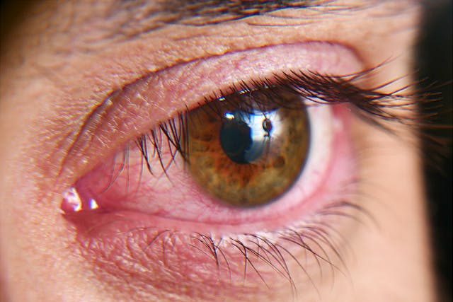 Patient with red eye | Image Credit: Kryuchka Yaroslav - stock.adobe.com